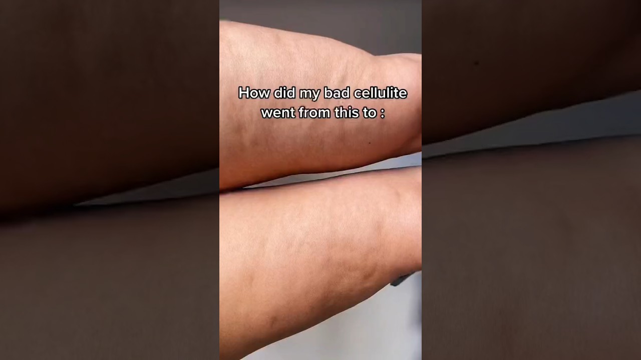 Cellulite Removal with Gua Sha tool #skincare #skincareroutine #beauty #beautiful #skincaretips