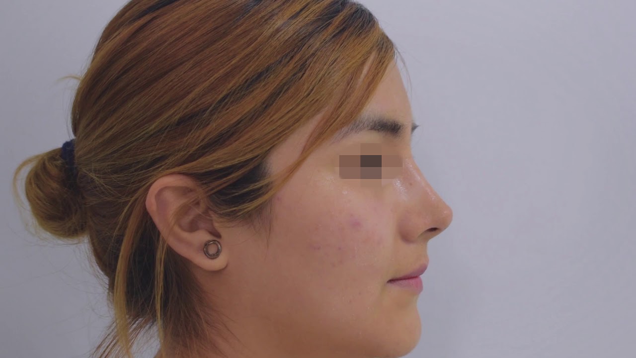 Resultados de Cirugía de Rinoplastia