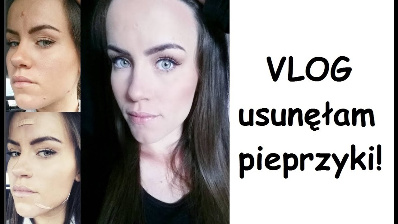 Vlog - usunęłam pieprzyki!