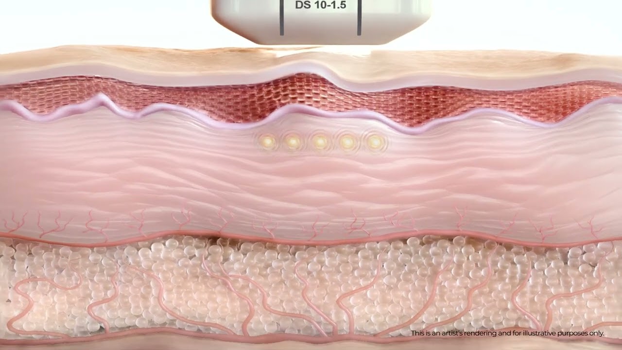 Merz Aesthetics Announces the Launch of Ultherapy PRIME Platform as the Next Generation of ...