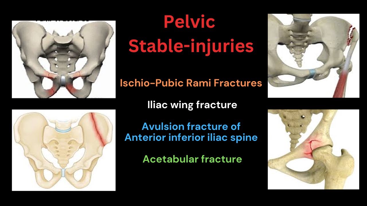 Pelvic stable injuries || Fractures of Ischio-Pubic Rami, Iliac wing, AIIS & Acetabulam