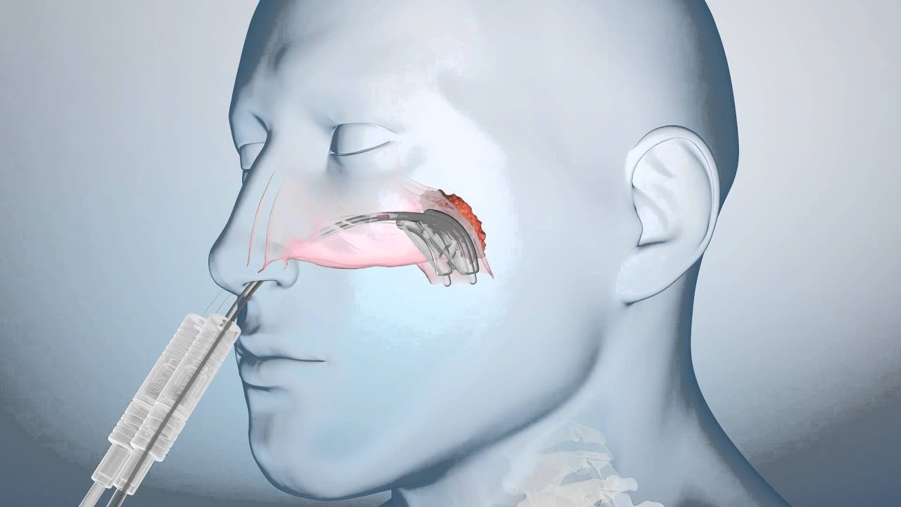 Eckert & Ziegler BEBIG: How HDR Brachytherapy/Afterloading works