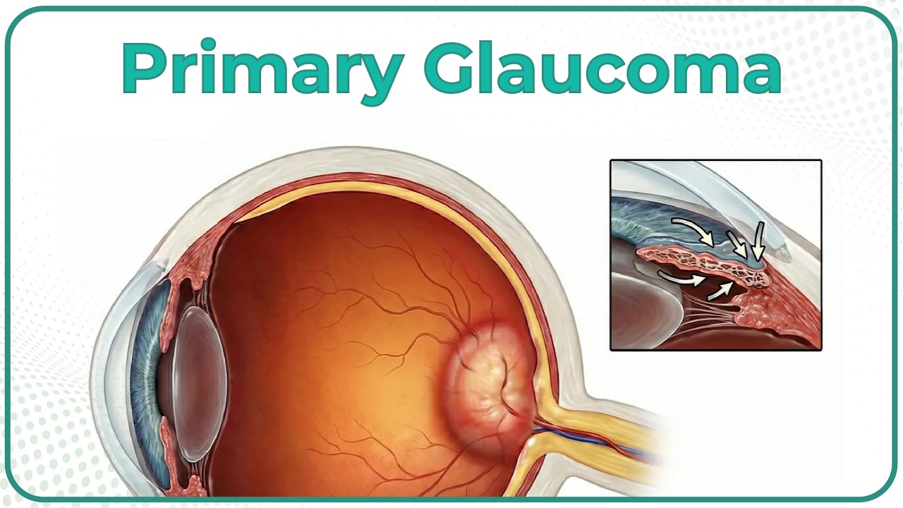 Primary Glaucoma 👁 : Ophthalmology Lecture