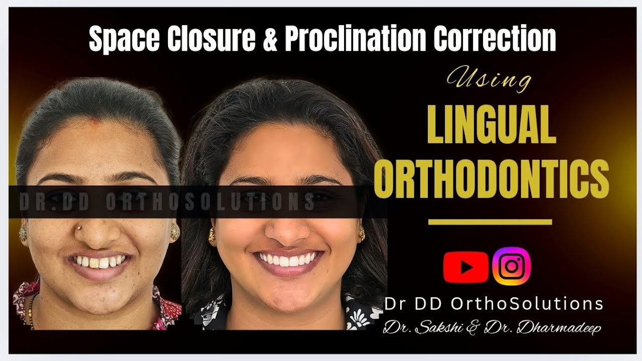 Sequential Space Closure and Proclination Correction using Lingual Orthodontics 