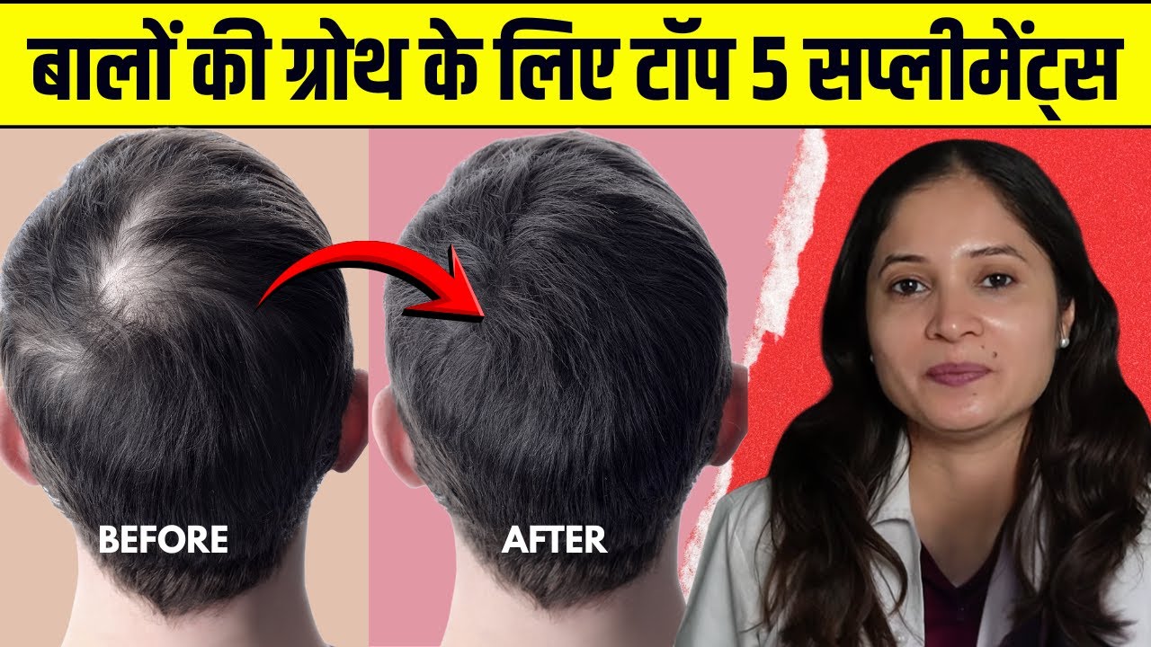 5 Supplements for hair growth | Video by Dr. Smita Bhoir Patil