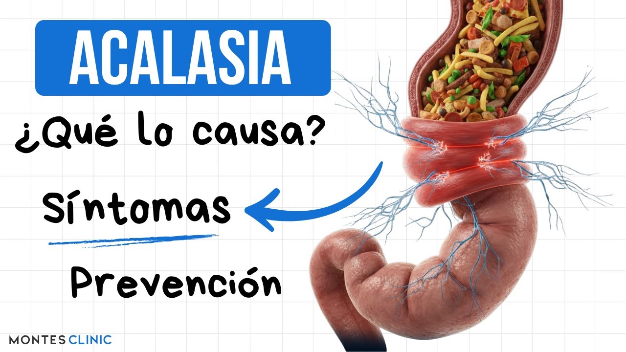 🔴 ACALASIA: ¿Qué la Causa? Síntomas y Tratamiento