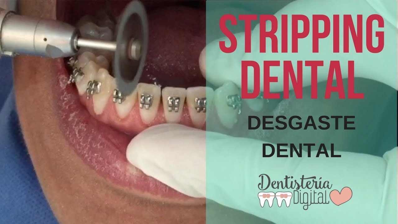 STRIPPING EN ORTODONCIA / Interproximal Reduction