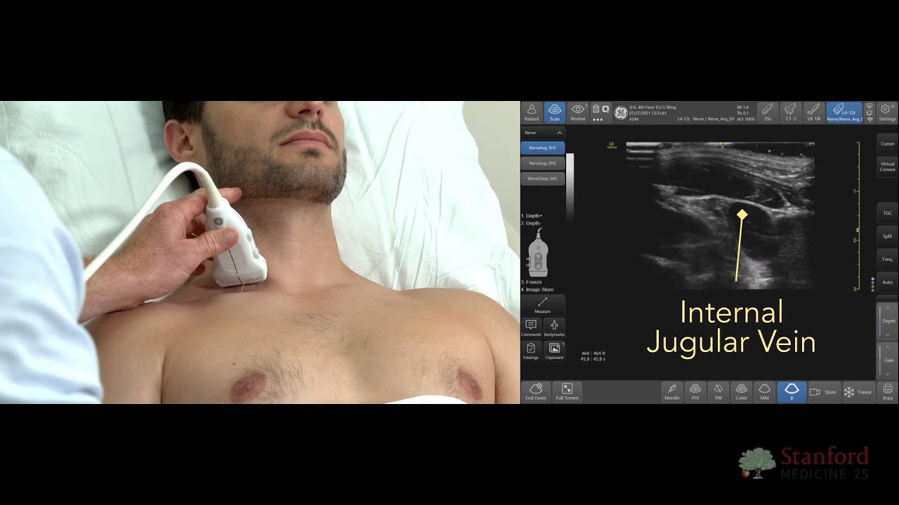 Using Ultrasound to Examine Neck Veins (POCUS)