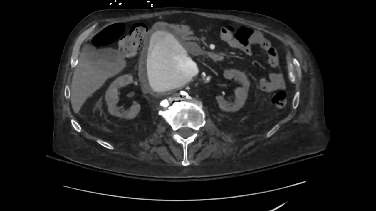 CT features of an unstable abdominal aortic aneurysm
