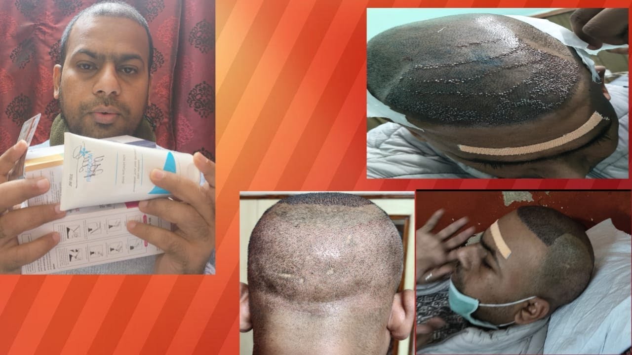 Hair transplant results after 52 days transformation prececaution every  dard#viral 🔥#ytshortsindia