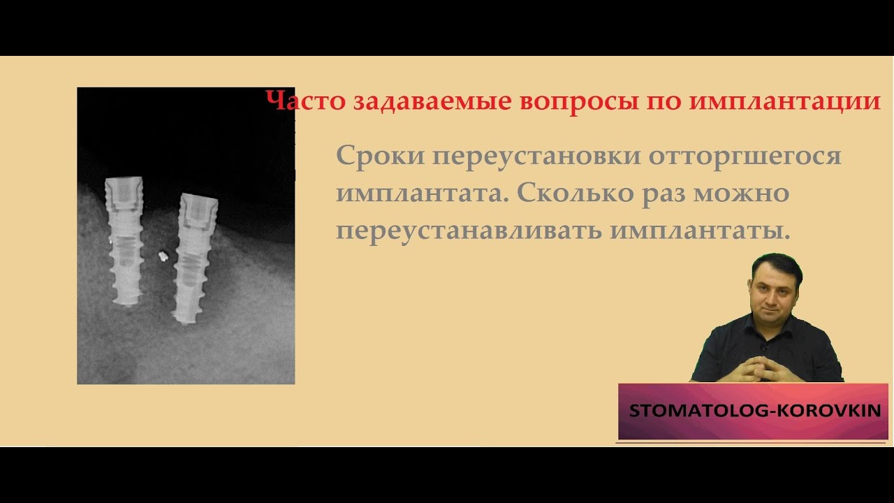 Сроки переустановки отторгшегося импланта. Как часто можно реимплантироваться. ЧЗВПИ.