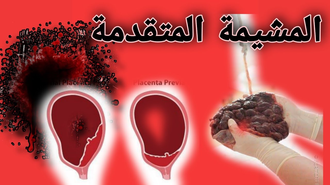 ما هي المشيمة المتقدمة وكيفية علاجها ؟