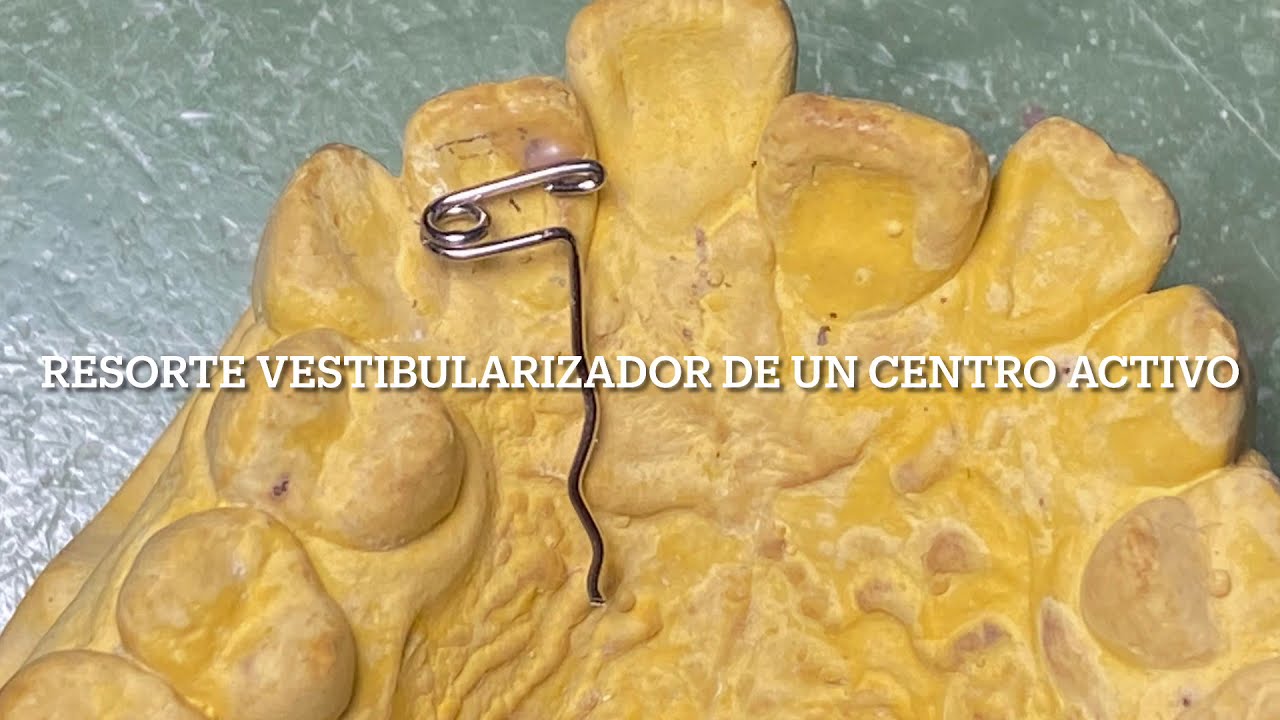 Resorte vestibularizador de un centro activo
