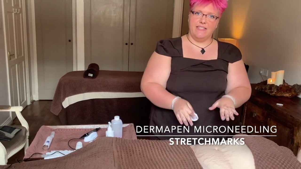 Dermapen Microneedling - How to reduce stretch marks, including before & after photos.