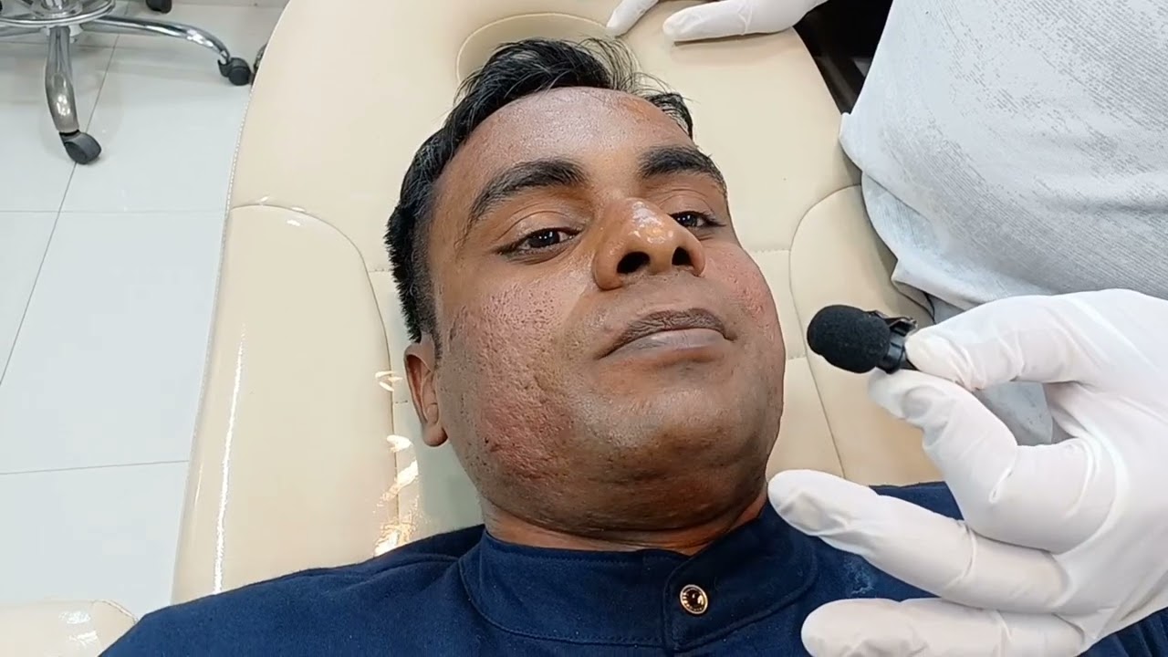 Results Dekho Acne Scar Treatment | Best Treatment for Acne Scars | Face Scar Treatment Results.