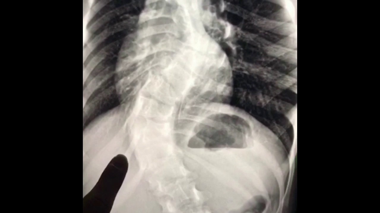 Magnetic rods treatment for early onset scoliosis