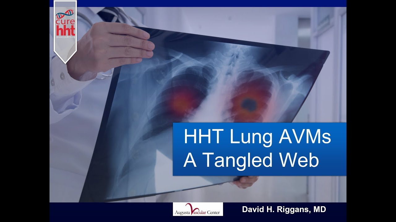 HHT Lung AVMs - A Tangled Web