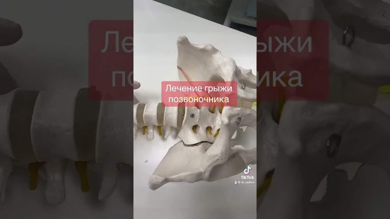 Как освободить нерв при грыже диска.￼