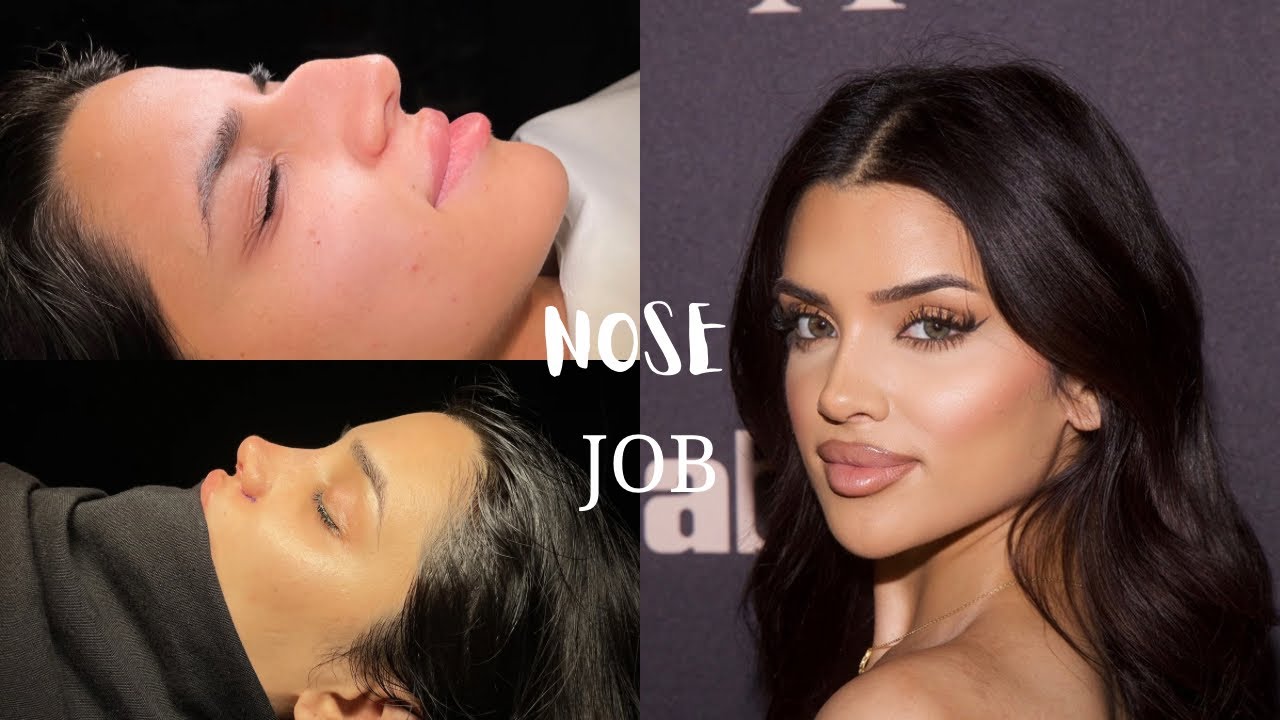 My Rhinoplasty Before And After — Was It Worth It?
