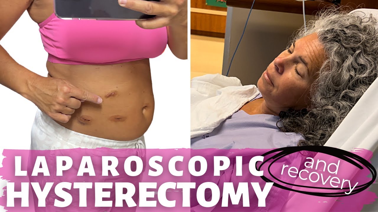 My Laparoscopic Hysterectomy Story & Recovery | Surgical Menopause What to Expect
