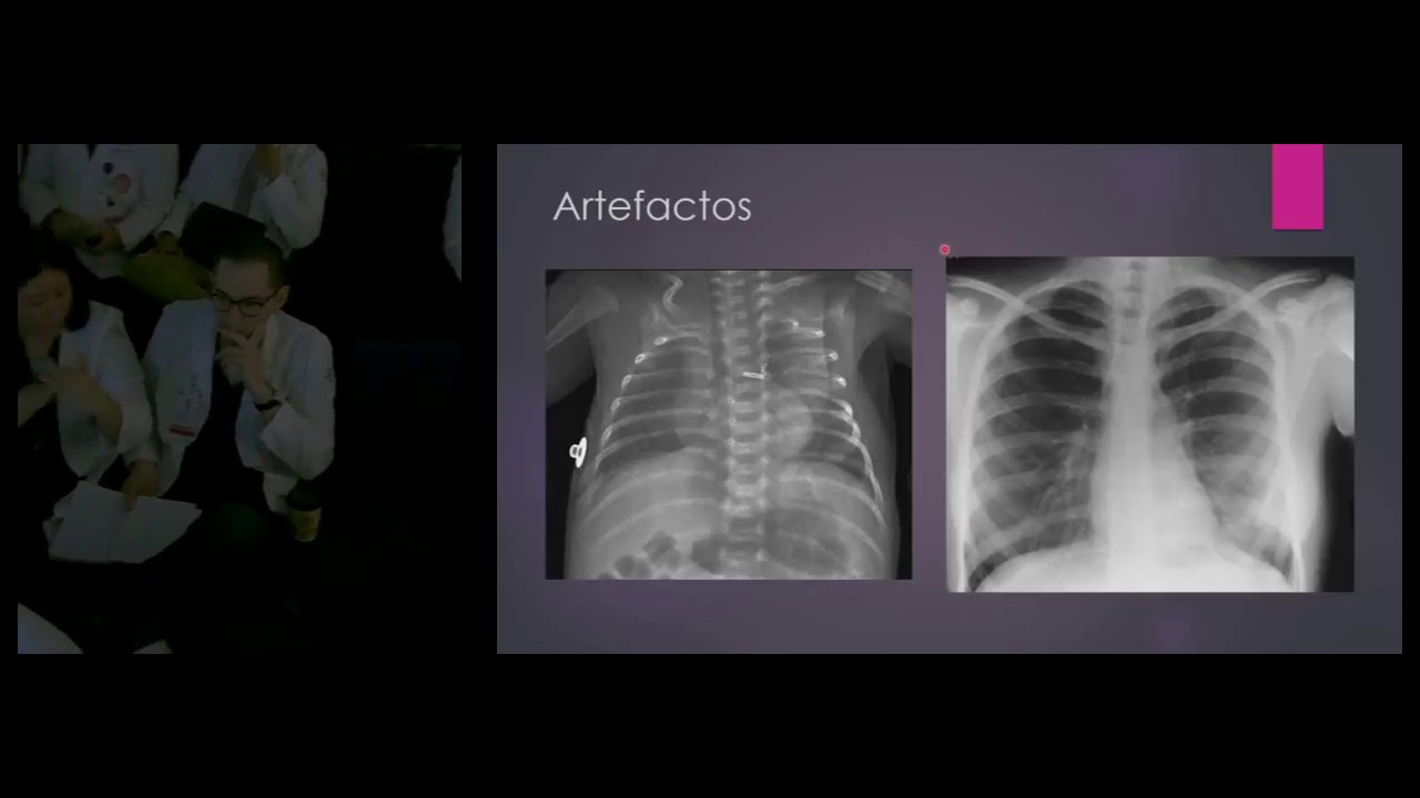 Tórax neonatal. Dra. Andrea Garza