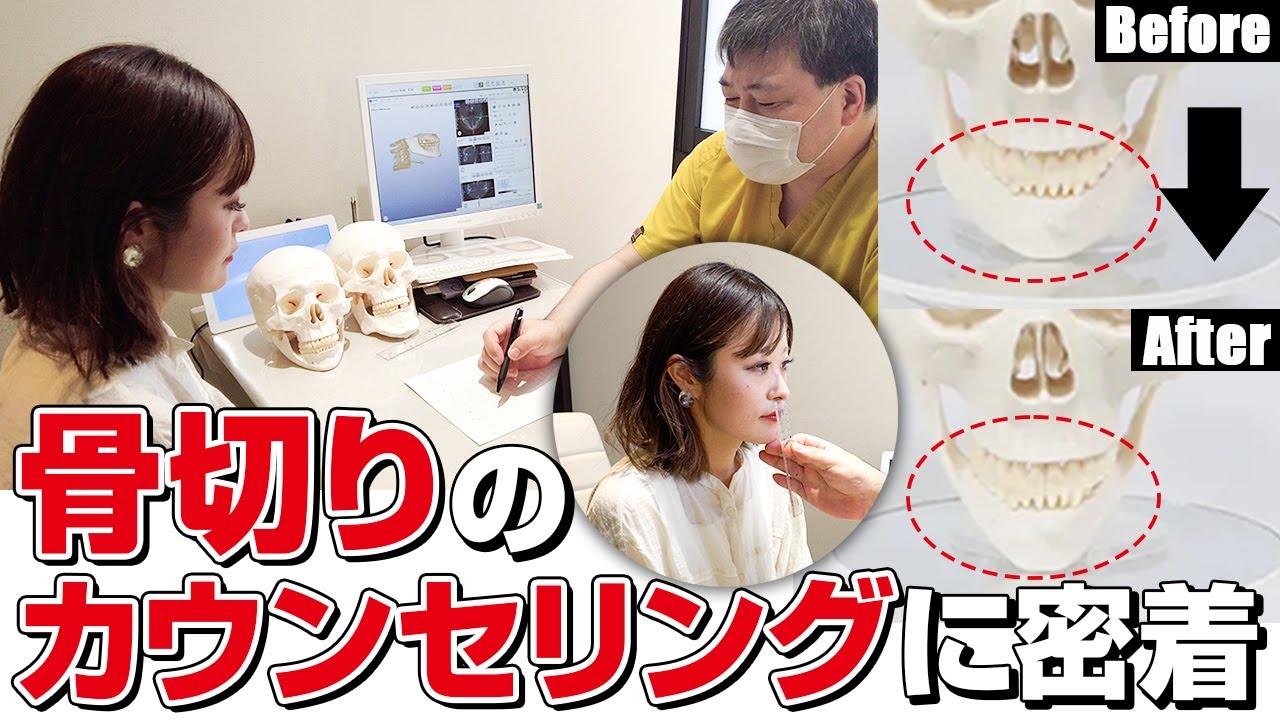 【骨切り・輪郭整形】共立美容外科の骨切りカウンセリングを大公開！【症例写真アリ】