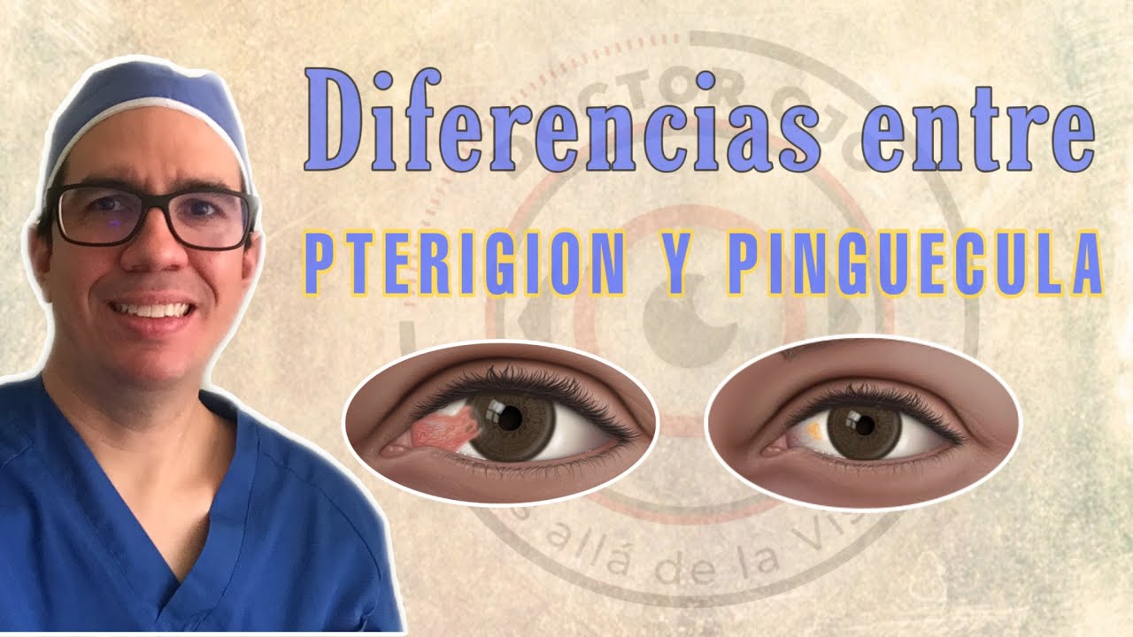 👀Cual es la DIFERENCIA entre PTERIGION Y PINGUECULA [2020] 👁🏥🤓