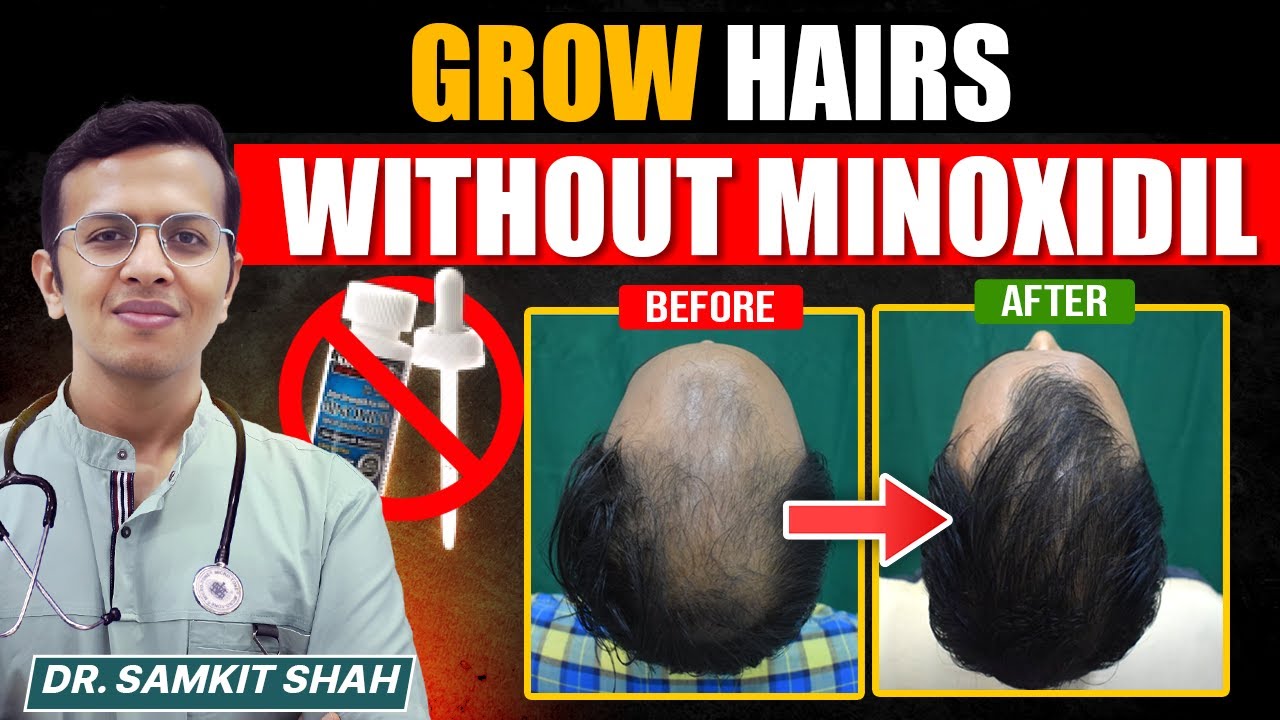 Say GOODBYE To Hair Loss In 30 Days Without Minoxidil (Top Doctor Advice)