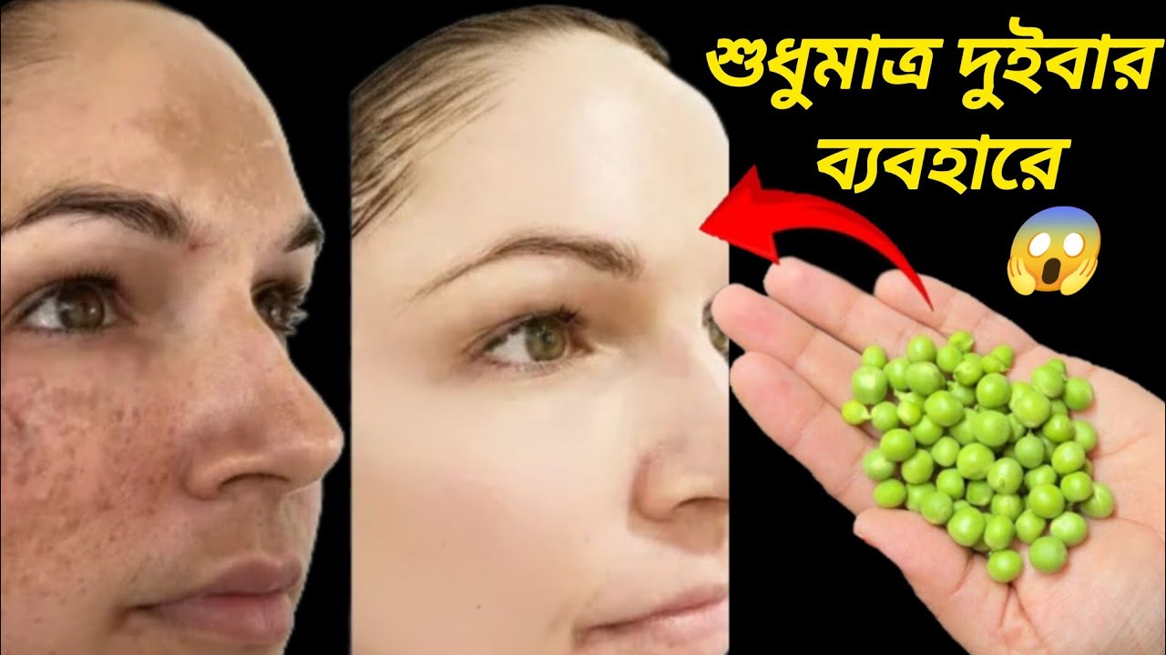 দুই ফোঁটা লাগালে মুখ আয়নার মতো জ্বলজ্বল করতে শুরু করবে ১০ বছরের পুরনো কালো দাগ সব পরিষ্কার হবে/