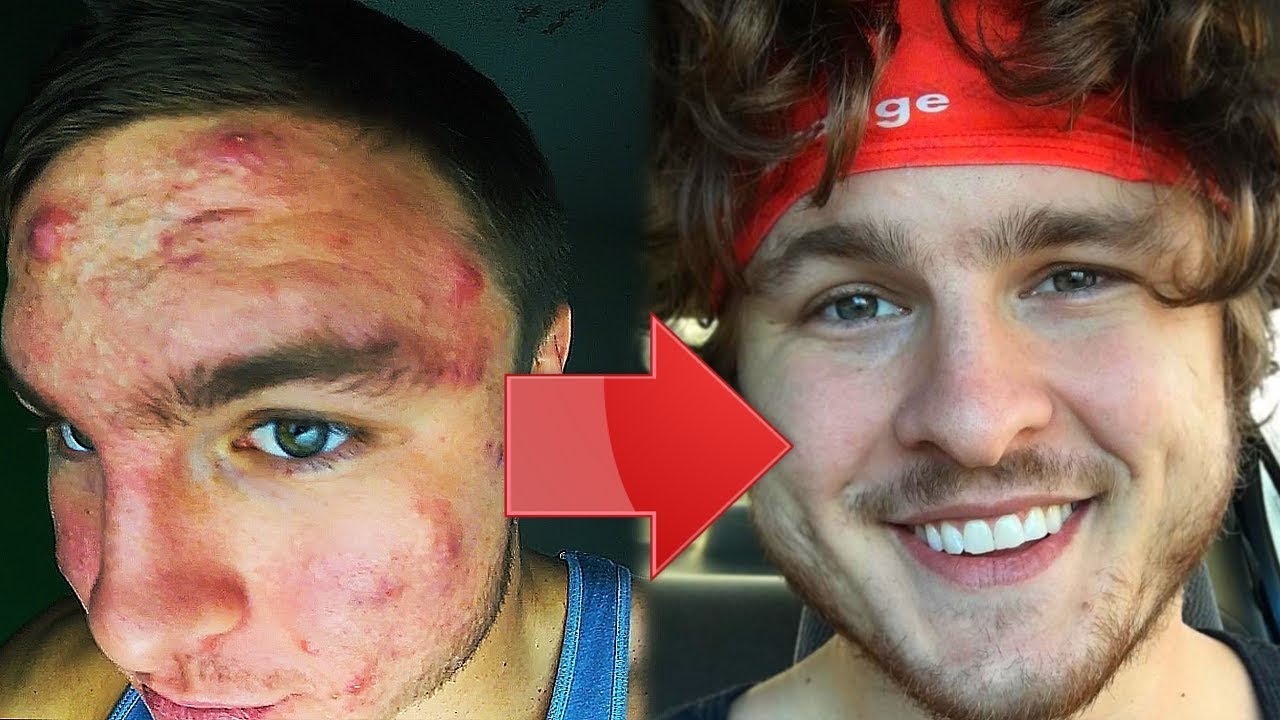 I Cleared My Severe Acne After 7 Years | HERE'S HOW