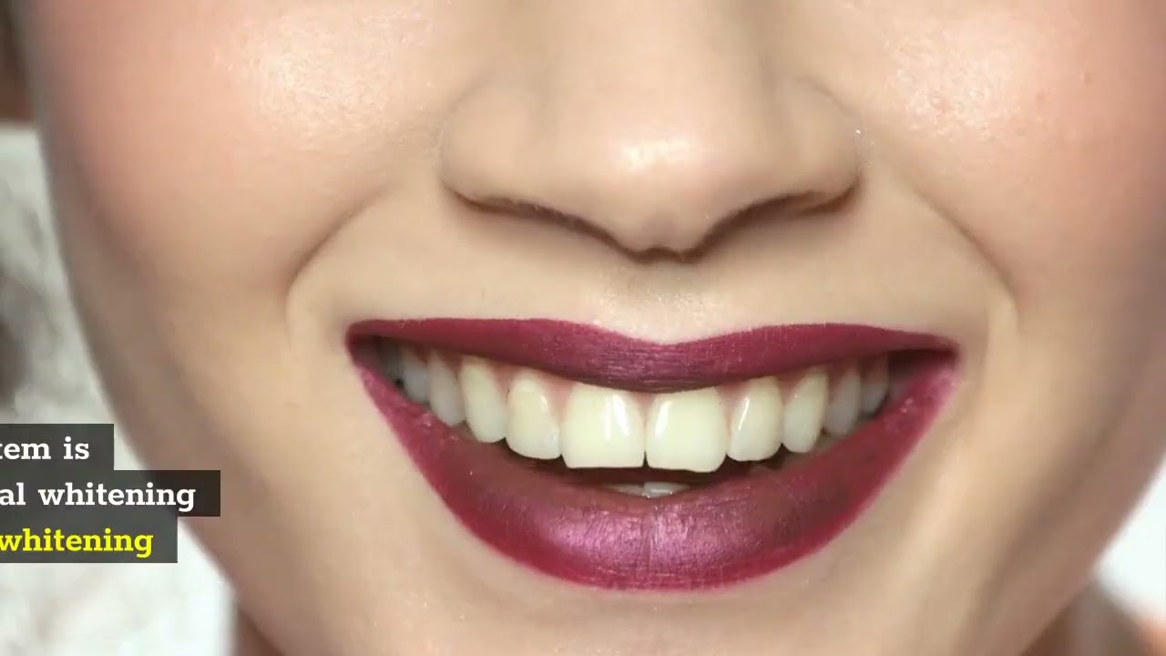 Teeth Whitening Brampton Dentist