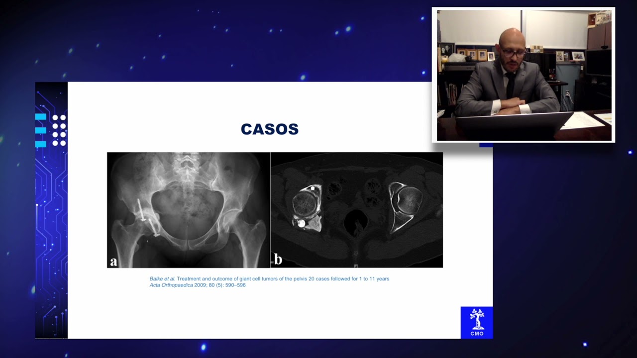 Manejo del tumor óseo de células gigantes de pelvis