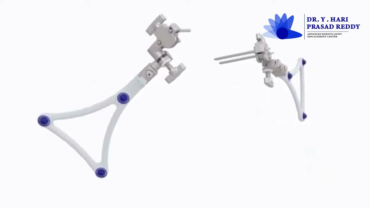 Advance Robotics for Knee Replacement Surgery In Kurnool by Dr. HariPrasad Reddy #robotickneesurgery