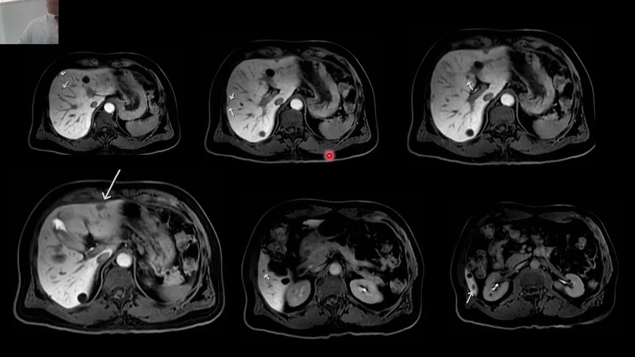 Aplicaciones y uso del Contraste Hepatoespecíficos