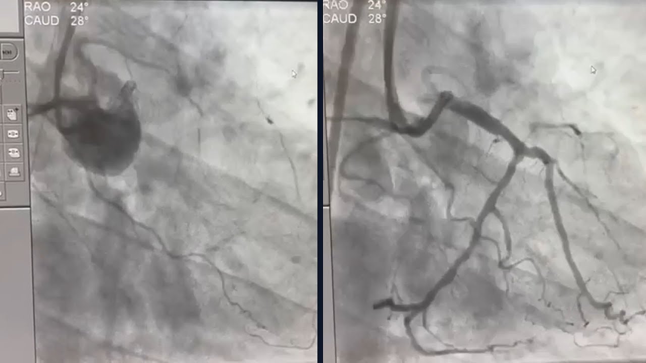 Complex PTCA to LM LAD in case of ostial LAD CTO - Dr Md Faizuddin