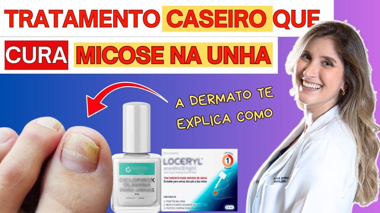 Como CURAR MICOSE na UNHA Antiga em casa- Loceryl/ Micolamina –[Dermato Explica]