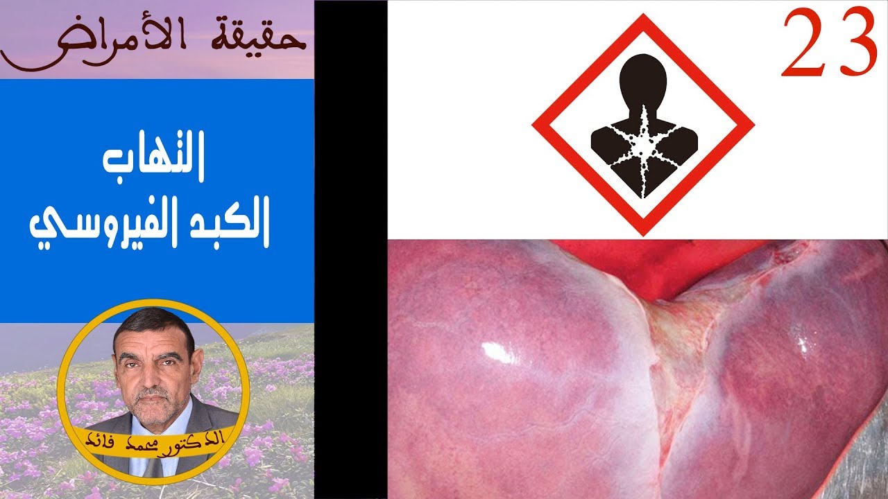التهاب الكبد الفيروسي | الدكتور محمد فائد