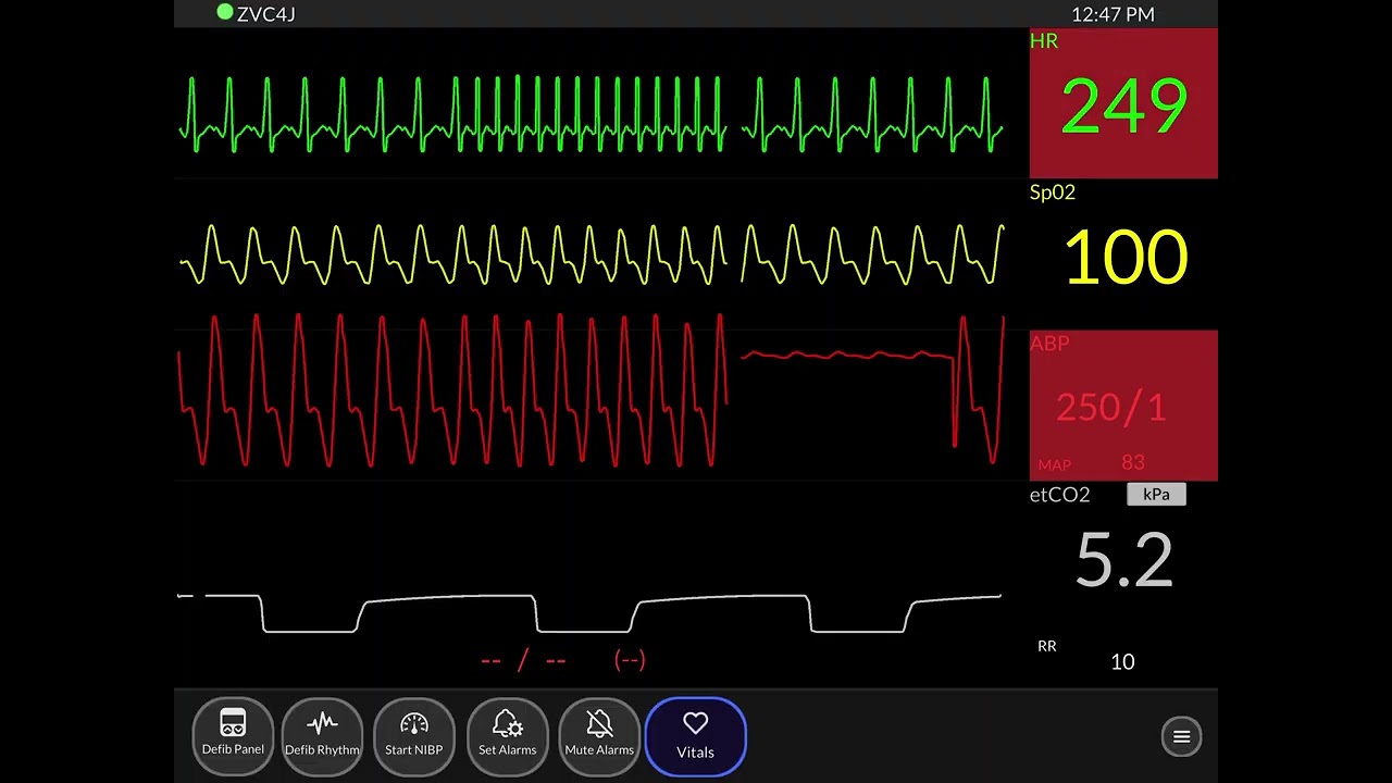 ECG Part II @ASCardiology 
