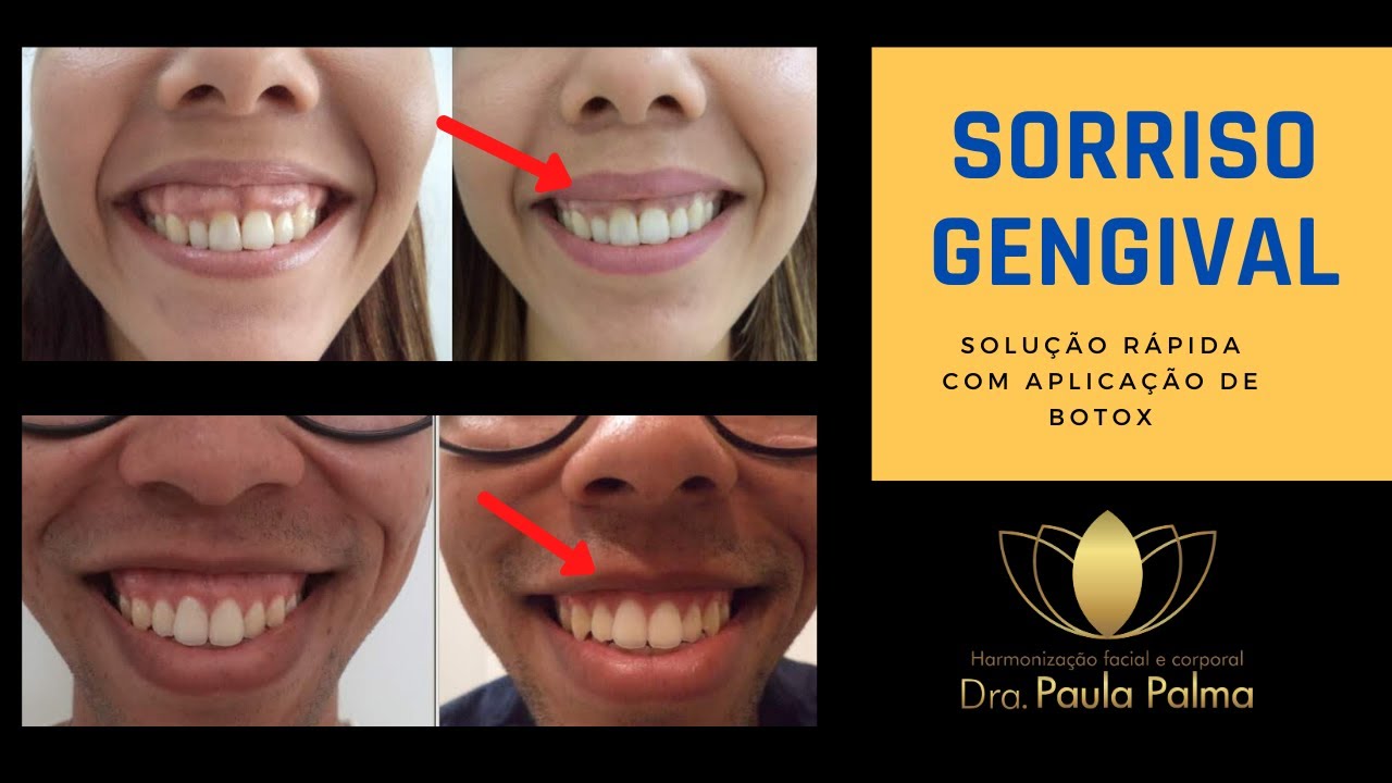 Sorriso gengival, como corrigir com toxina botulínica - Botox -  veja antes e depois da aplicação.