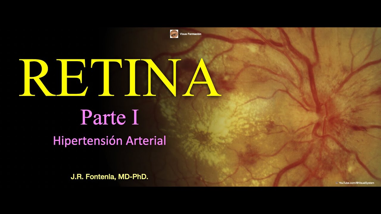 Retina (Parte I). Hipertensión Arterial. Retinopatía Hipertensiva.