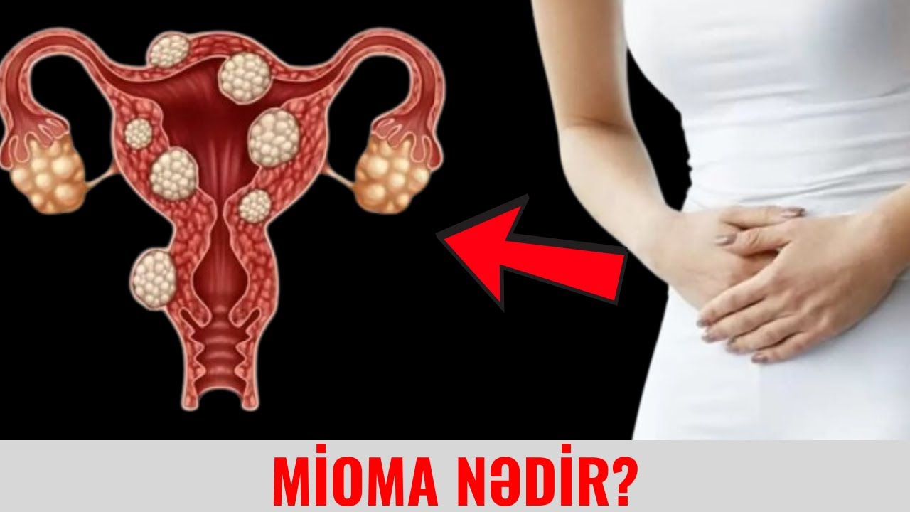 Mioma nədir?