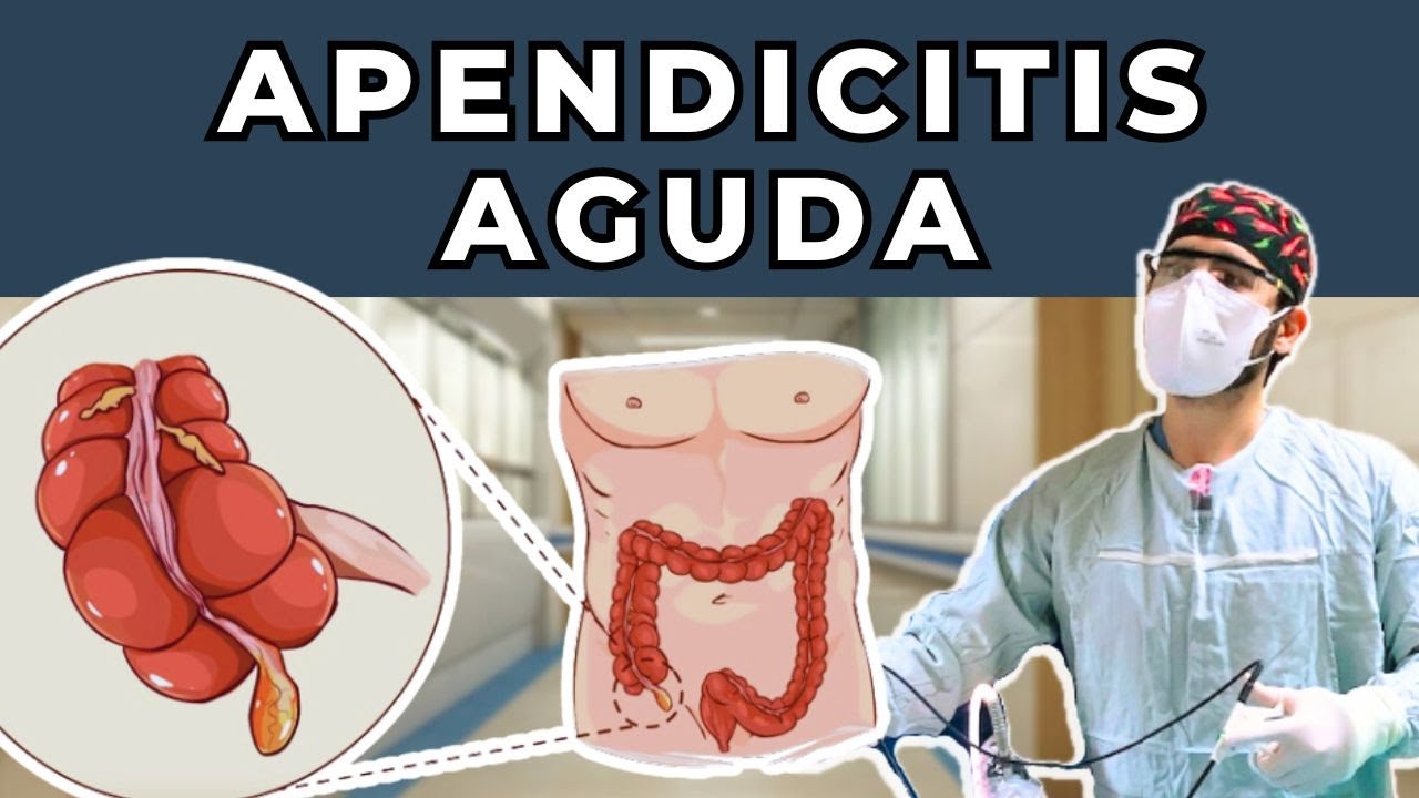 ¡APENDICITIS AGUDA! Cirugía de URGENCIA más común - Síntomas, Diagnóstico, Tratamiento