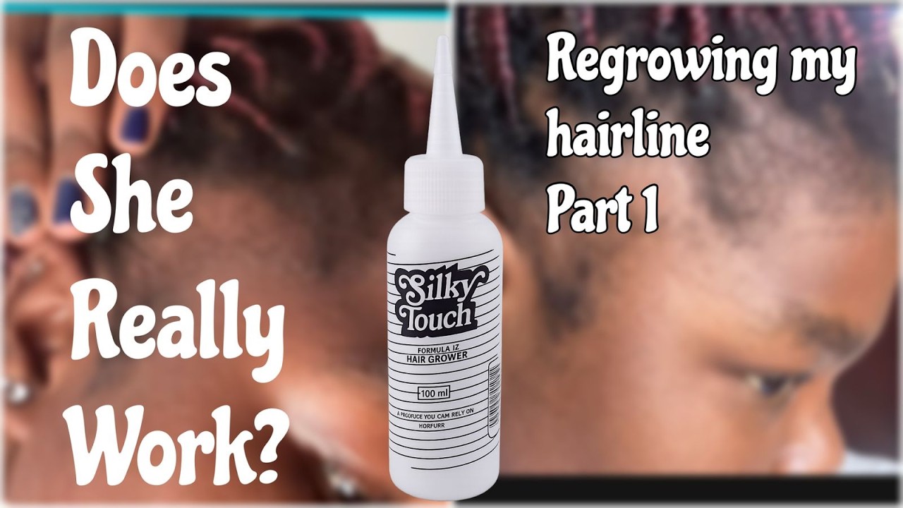 Regrowing my hairline...part 1