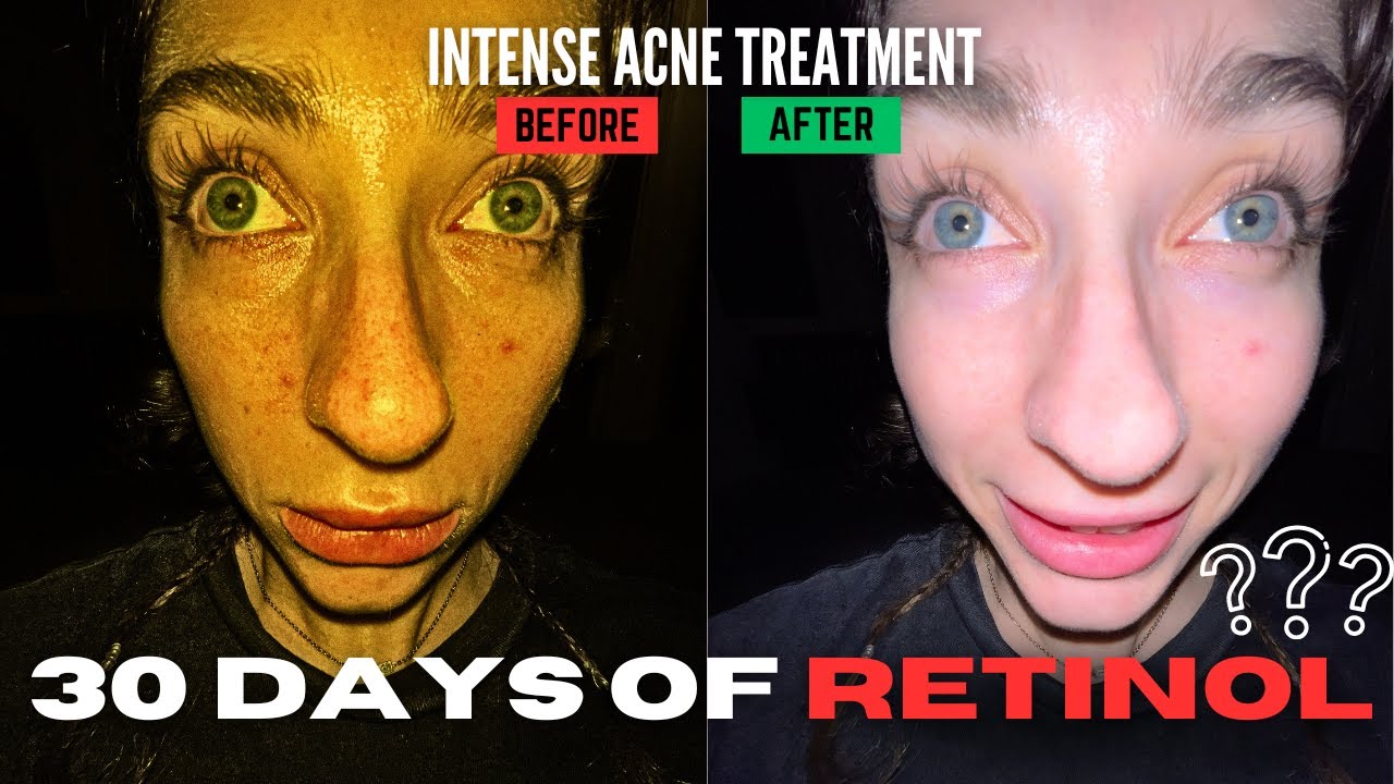 I tried TRETINOIN for 30 days... | acne treatment full documentation