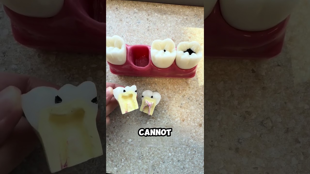 A Dentist&rsquo;s Warning on the Dangers of Cavities!