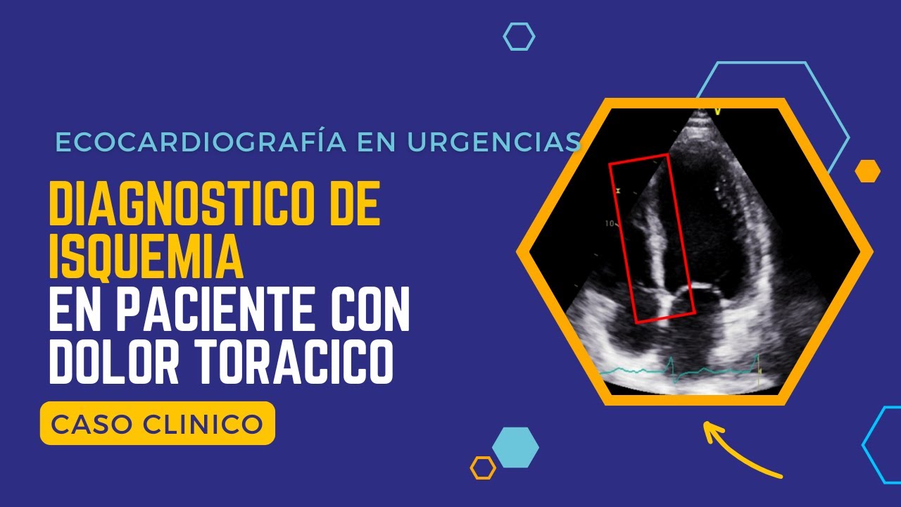 ✅ECOCARDIOGRAMA EN URGENCIAS: Diagnóstico de ISQUEMIA en un paciente con DOLOR TORÁCICO⚠️