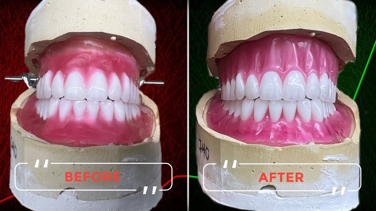Full Denture Wax-Up 🔥 Ready for Try-In!