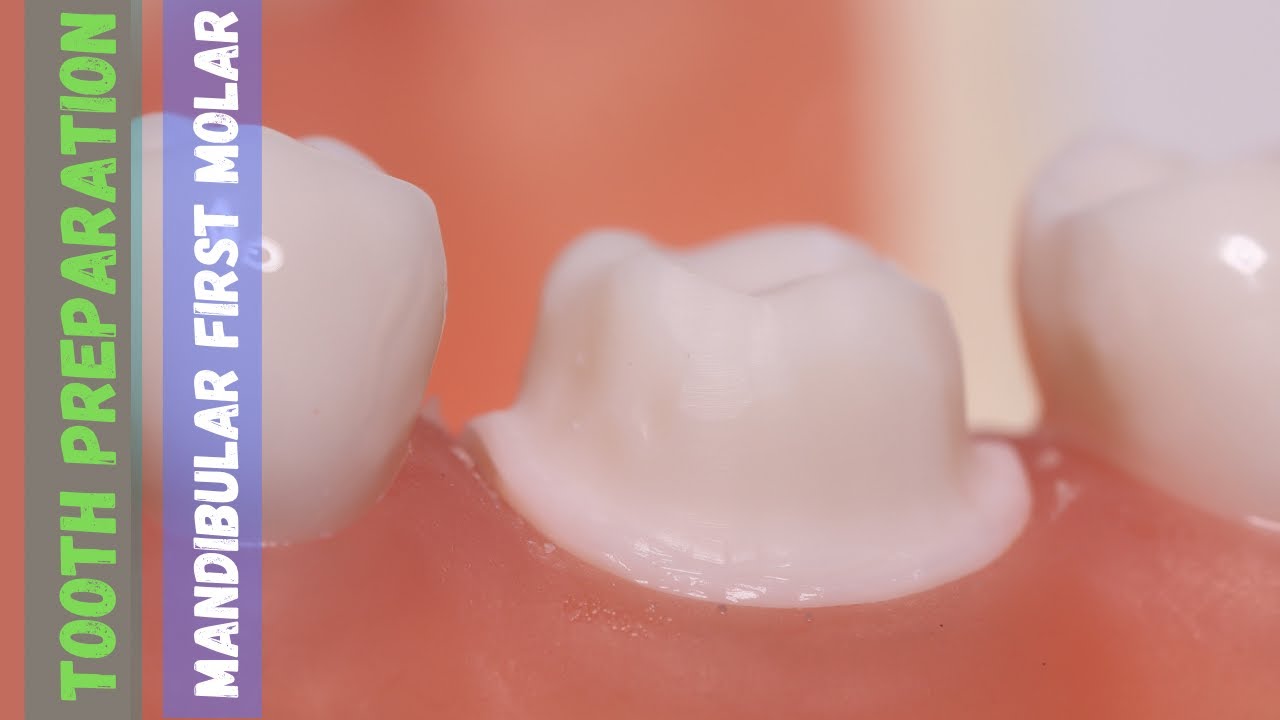 Mandibular First Molar 🔵 Tooth Preparation for PFM 🟡 Step by Step Demonstration