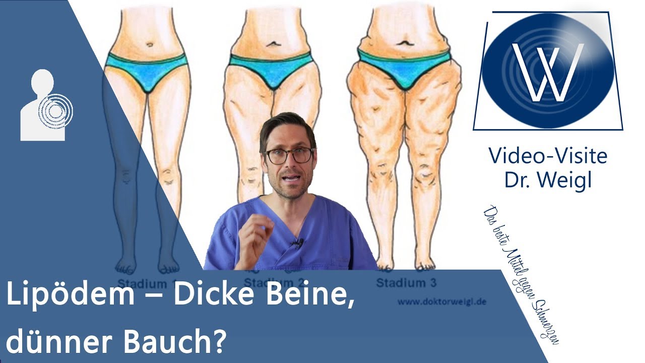 Lipödem: Warum habe ich dicke Beine & was kann ich dagegen tun? Ursachen, Symptome & Therapie