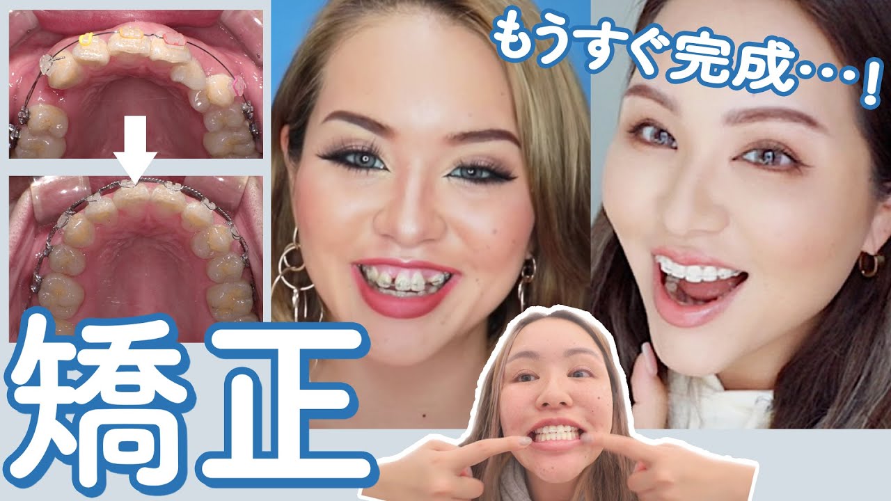 【矯正】完成間近！総額いくら？セラミックにしなかった理由は？